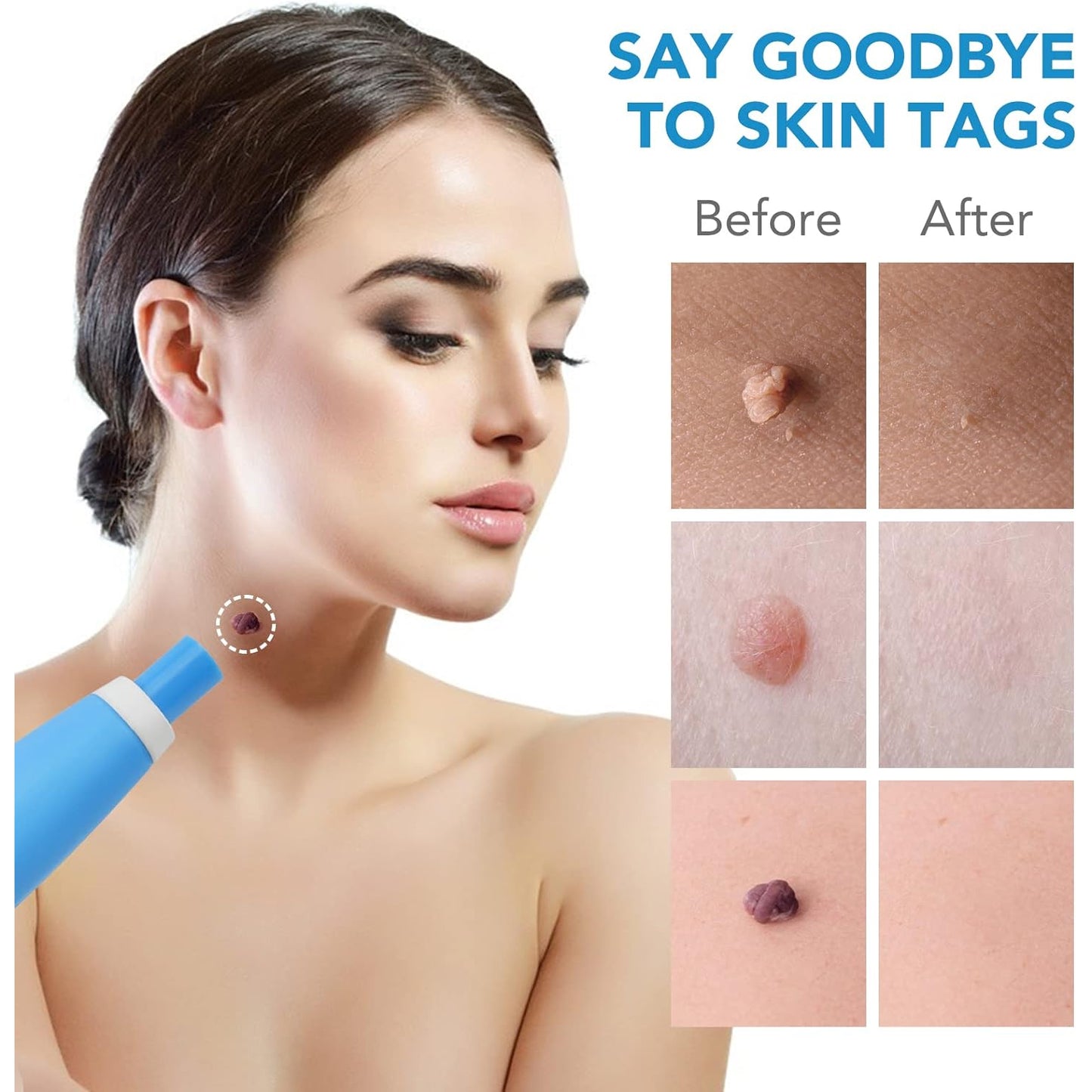 Skin Tag Remover Kit 2 In 1 For Micro To Large (2 Mm - 8 Mm 1 Set)